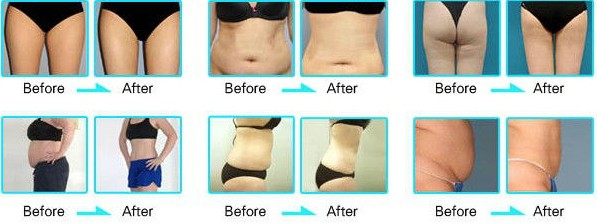 2019 Nubway hot sale best selling cool tech cryolipolysis 2 handle fat freezing machine
