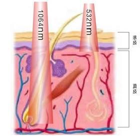 Latest design factory price most popular fast speed pigment removal ND-YAG machine