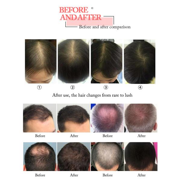 660nm Diode Laser Hair Growth Machine , Anti Hair Loss Treatment Machine