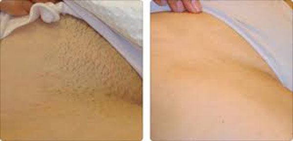 NUBWAY 2019 hot sale professional beauty salon use portable mini diode laser 808nm hair removal machine