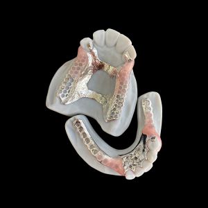 China Custom Metal Framework Partial Denture with Invisible Clasps for Precision Fit and Superior Esthetics on sale