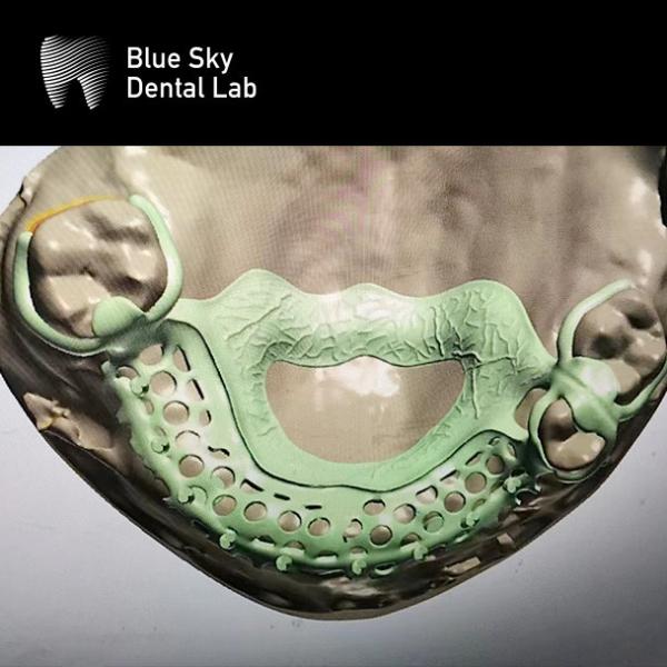 Lightweight Acrylic Resin Partial Denture With Metal Frame Realistic Looking Dentures