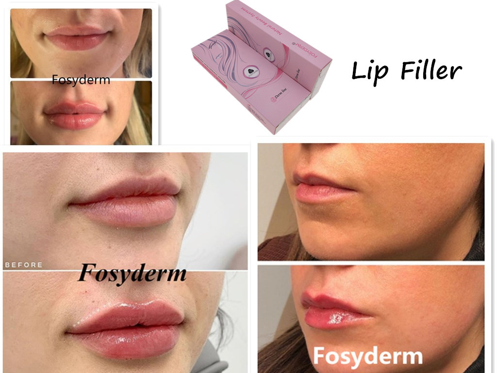 Facial Hyaluronic Acid Dermal Filler With Syringe For Lip Nose Chin Cheek 24mg