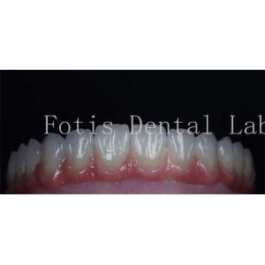 Quality Smooth Surface Cosmetic Tooth Coverings Natural Porcelain Veneers Customizable wholesale