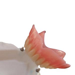 Quality High Biocompatibility Precision Attachment Denture CAD-CAM Implant wholesale
