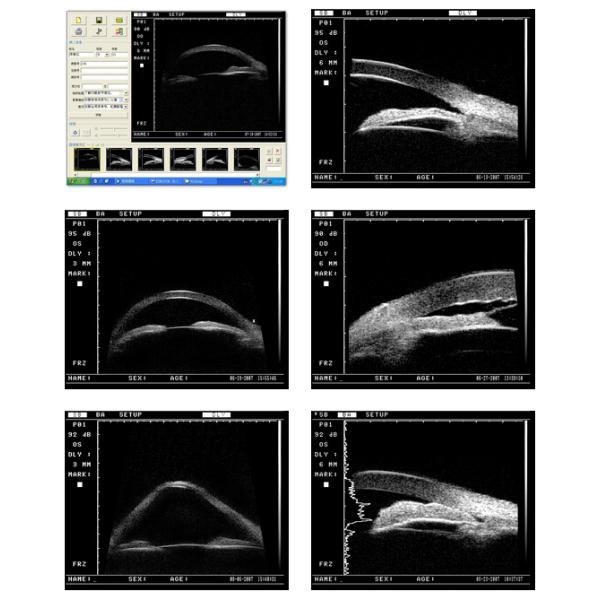 MD-320W ophthalmic Portable Ultrasound Biomicroscope medical equipment solutions