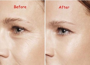 1ml Injectable Hyaluronic Acid Dermal Filler , HA Dermal Fillers For Fine Wrinkles