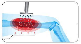 Monopolar Rf Body Slimming Machine Physiotherapy Diathermy Face Lift