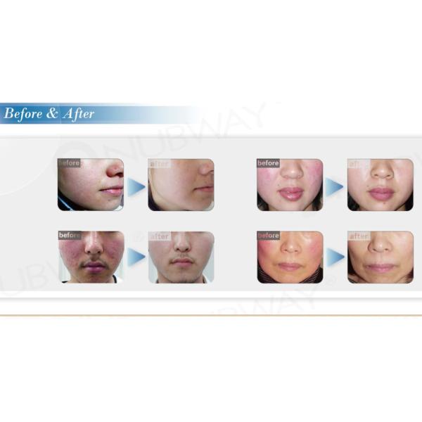 china best effective 30Mhz painfree RBS laser spider veins laser removal machine (nbw-v600