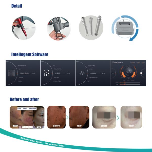 Gynecology CO2 Laser System