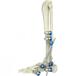 China Medical Orthopedic Instrument Ankle External Fixation Device on sale