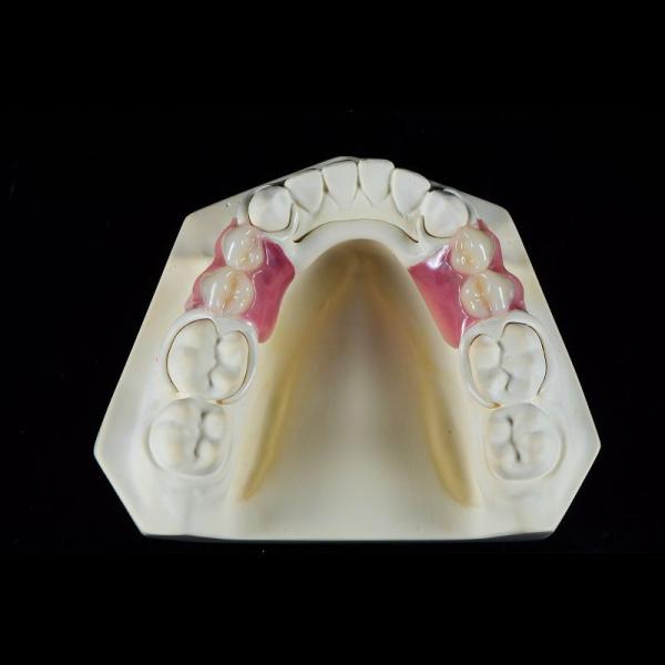 OEM Peek Cast Metal Framework Partial Denture User Friendly