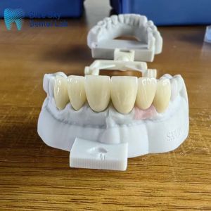 Highly Translucent Layered Zirconia Crowns Natural With Implant Crown