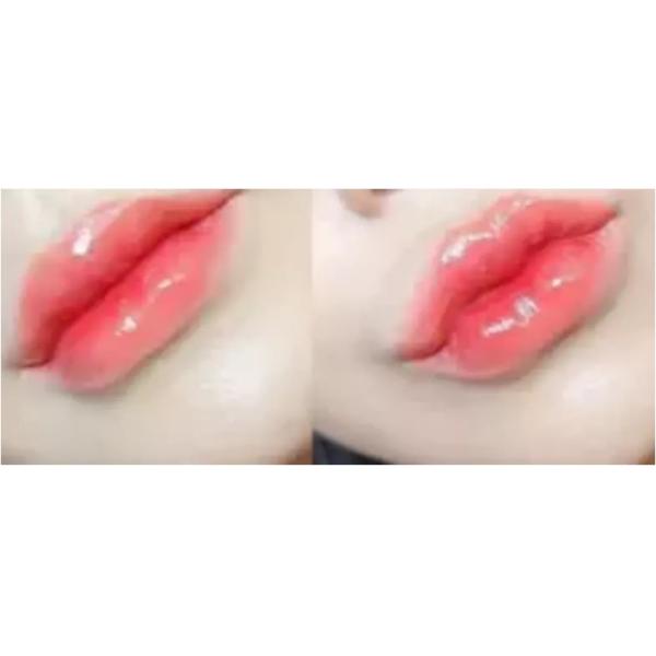 2cc Cross Linked Hyaluronic Acid Gel For Body Breast Neck Nose Foot Hand Face