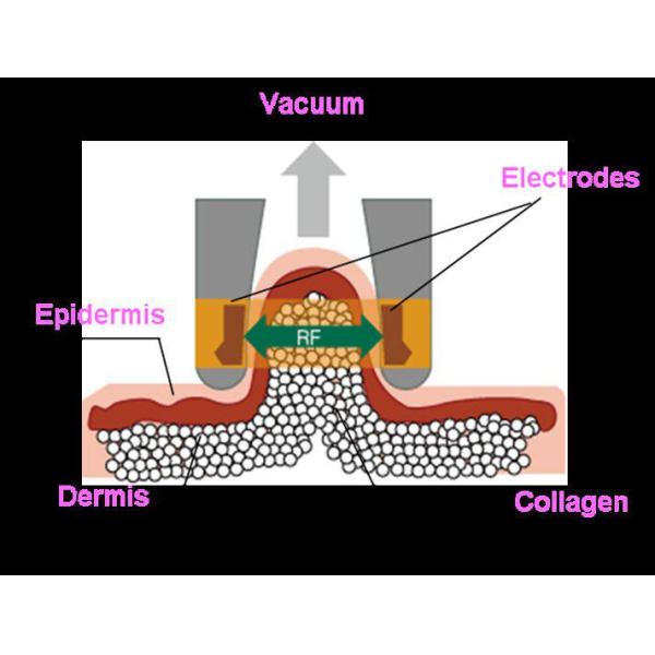 V8-Shape cavitation vacuum +RF weight loss /slimming machine
