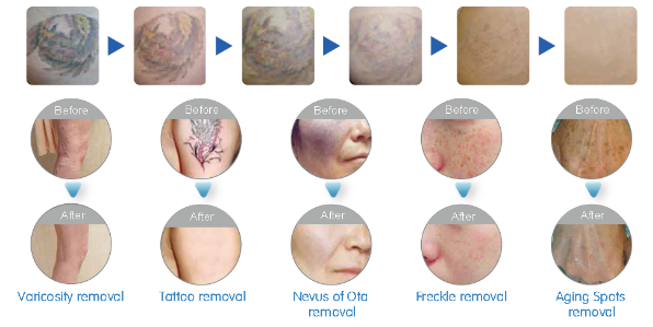 Q Switched ND YAG Laser Tattoo RemovalMachine with CE certification,3 years warranty.