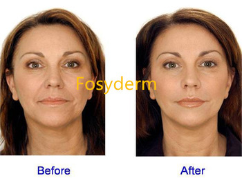 Cross Linked Wrinkle Dermal Filler Hyaluronic Acid Facial Filler Injection 1ml Fine Line
