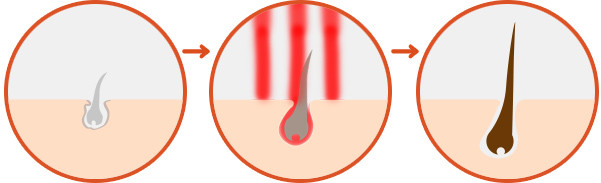 300 Watts Clinic Laser Treatment For Hair Loss , Low Level Laser Therapy Hair Loss Painless