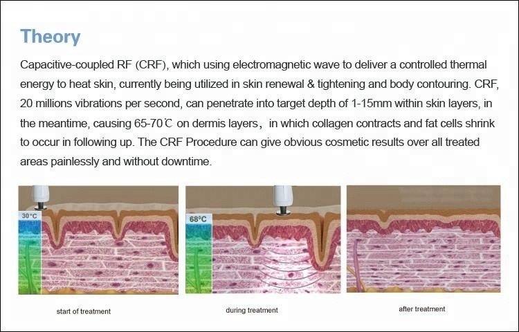 Non Invasive Thermage RF Machine Fractional Radio Frequency Machine for Face Lift