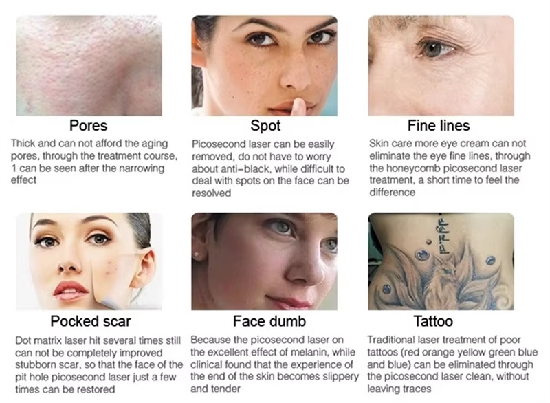 Picosecond Nd Yag Laser Machine For Freckles Removal Eyebrow Removal