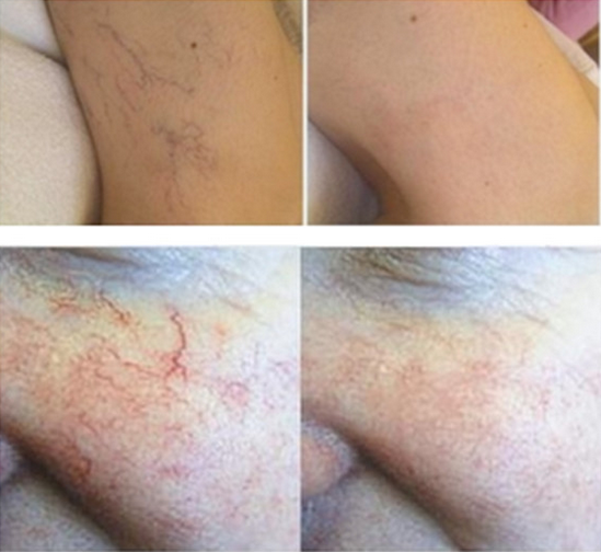 980nm Diode Laser Skin Tag Removal Machine , ND YAG Laser Machine For Tattoo Removal