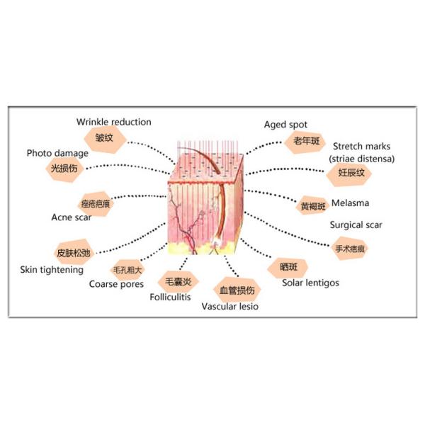 40W 10600 nm RF Metal Tube Fractional Co2 Laser For Acne Scars / Vaginal Treatment