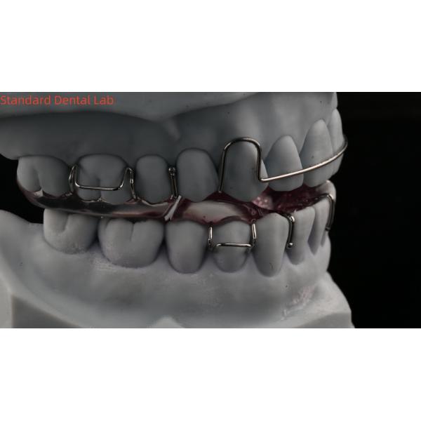 Teeth Expansion And Distalization Adjusting Expander In Mouth Orthodontist Palate Expander