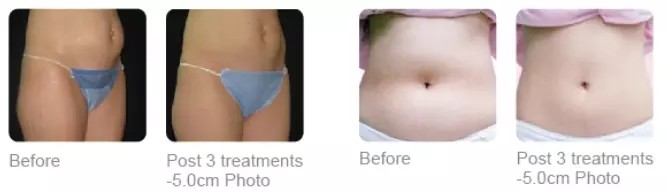 factory price ! Newest china nubway best ultrashape hifu selling rf machines slimmingliposuction cavitation