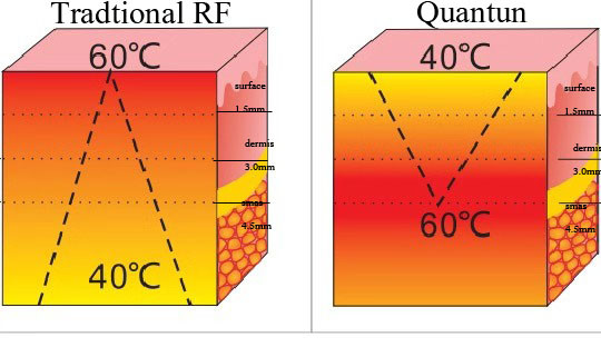 Facial Vibration Massager RF Beauty Machine 250W Radio Frequency Face Lift Machine