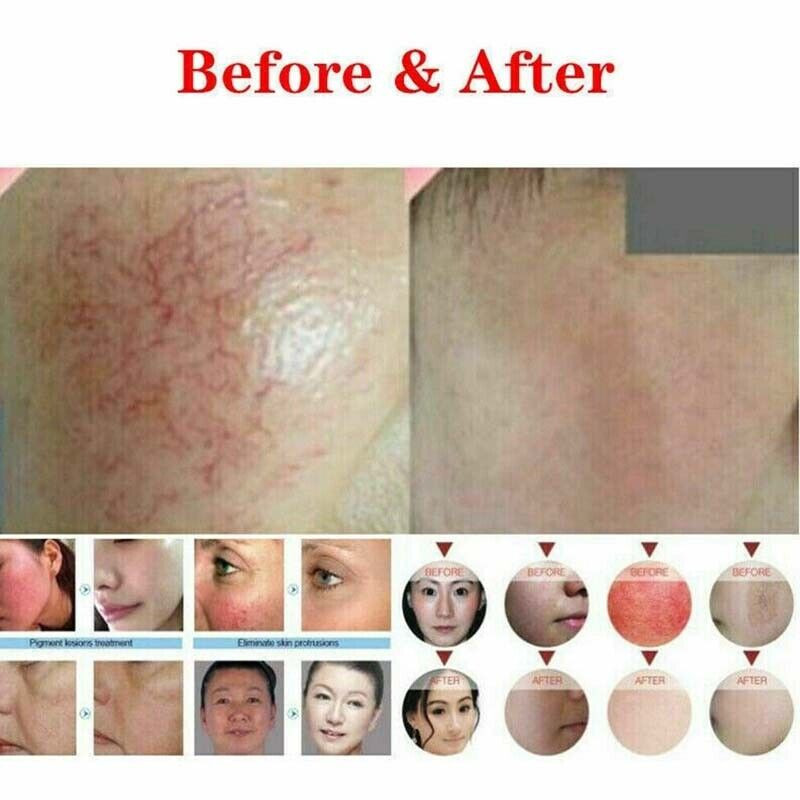 Ce Medical 980 Diode Laser Beauty Machine Spider Veins Vascular Removal 15w / 20w / 30w