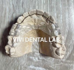 China Removable Dental Wire Teeth Orthodontic Retainer On Palatal Side 3-3 on sale