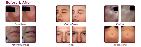 NUBWAY 0.3-3mm needle Professional Fractional RF microneedle radio frequency skin rejuvenation machine in best price