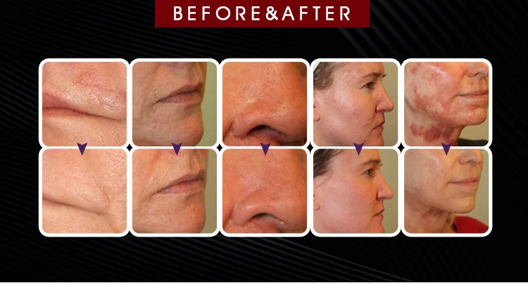 10600nm CO2 Fractional Laser Machine For Removal Acne Wrinkle Skin Rejuvenation
