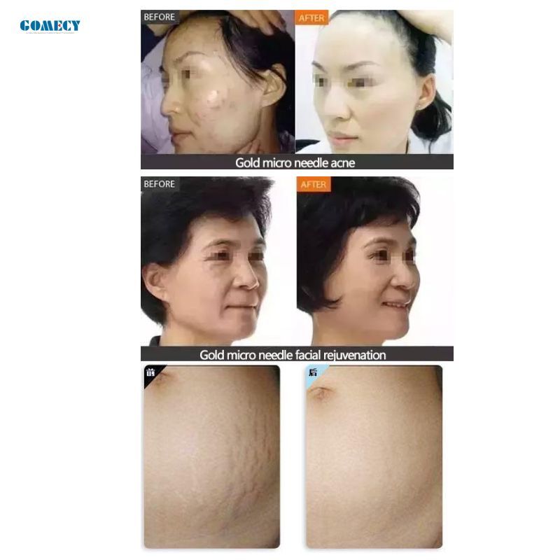 Fractional Microneedling Radio Frequency Machine for Pore Minimizing Skin Smoothing and Lifting