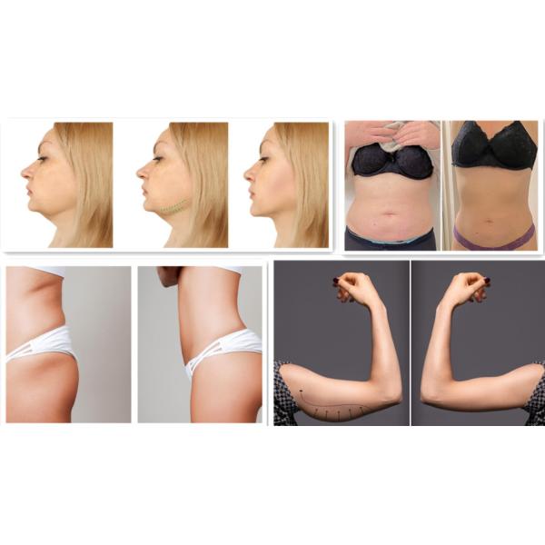 Weight Loss Injection Lipolysis Solution For Fat Dissolving