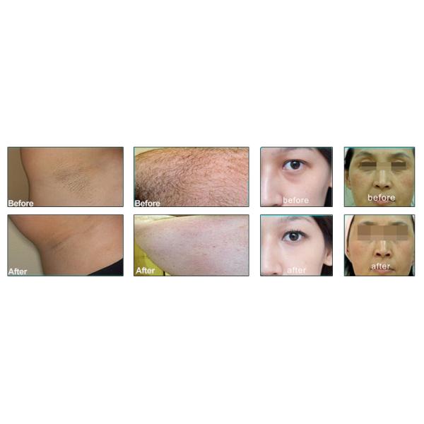 Portatil Diode Laser Hair Removal Machine 52kg Weight for Black Skin