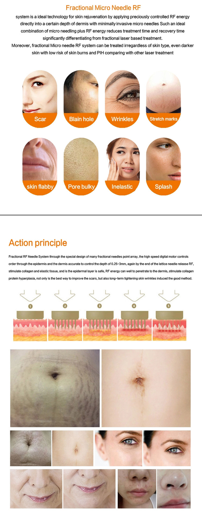 Gold Ice RF Microneedling Machine With Acne Removing Pen For Beauty Salon