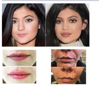 Lips Enhance Hyaluronic Acid Facial Filler With 0.10 - 0.15mm Particle Size
