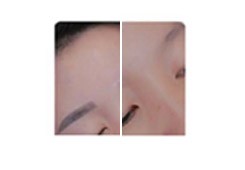 Picosecond Laser Tattoo Removal ND YAG Laser Equipment High Energy