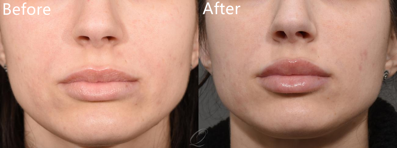 Injection Ha Filler Juvederm 2x1ml Lip Enhancement Remove Wrinkles