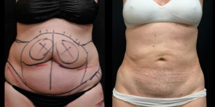General Surgery Laser Liposuction System Short Time Operation For Slimming Treatment