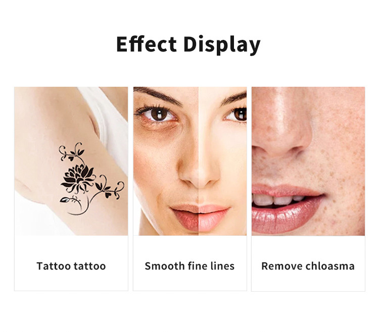 Q Switched ND Yag Laser Tattoo Removal Machine 1064nm Picosecond Laser Tattoo Removal Machine