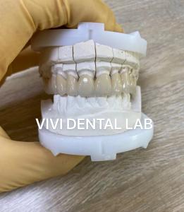 Quality Precise Dental Lab Crowns Esthetic Porcelain Zirconia Tooth Crown wholesale