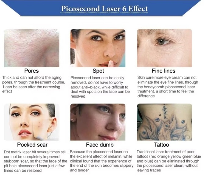 Tattoo Removal Machine Carbon Peeling Beauty Machine Picosecond Nd Yag Pico Laser Skin Equipment for Skin Whitening