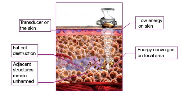 Hot promotion!!! Lastest HIFU Ultrasound Vacuum HIFU Body Fat Lipolysis Unit