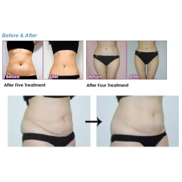 Fast Weight Loss Lipolytic Solution For Dissolving Fat