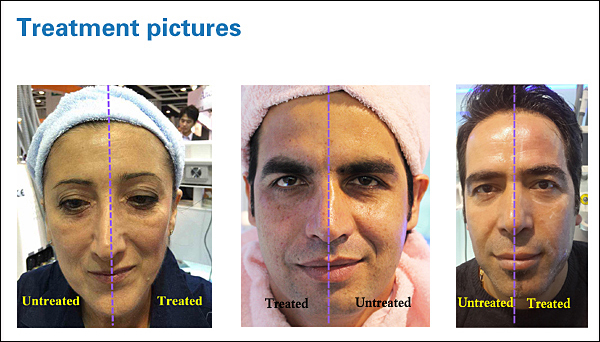 Best Anti-Aging High Intensity Focused Ultrasound Hifu Wrinkle Removal