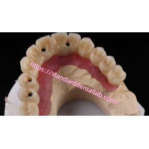 Multi Layer Zirconia Screw Retained Implant Bridge Biocompatible On Metal
