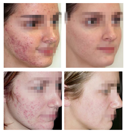 Fractional CO2 Laser Skin Rejuvenation wrinkle removal Acne scar removal for beauty