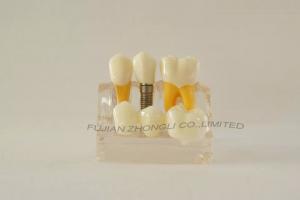 Dental Implant 3 Unit Bridge 3 Crowns Set of 6 Parts Model 4 Times Life-Size Reconstruction